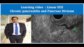 Linear EUS Learning video chronic pancreatitis Pancreas divisum Dr Vikas Singla [upl. by Enois]