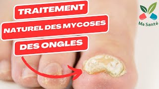 Traitement naturel des mycose  mycose pied  mycose ongle pied  mycose ongle main et les autres [upl. by Aseret]