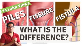 Piles  Fisure  Fistula  Difference explained  Dr Vishal Tomar  Open Consult [upl. by Destinee]