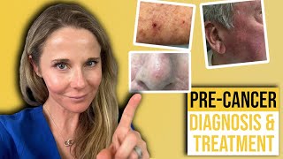 Actinic keratosis treatment guide from a Dermatologist [upl. by Kahl]