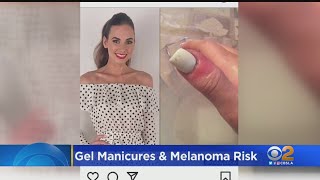 Woman Develops Melanoma After Receiving Gel Manicures [upl. by Eilojne242]