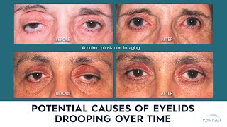 Possible Causes of Drooping Eyelids Eyelid Ptosis in Adults [upl. by Berliner501]