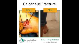 Calcaneus fracture [upl. by Haines669]