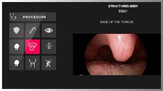 DIRECT LARYNGOSCOPY [upl. by Adnawad]