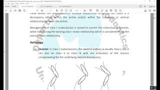 Treatment of Class I malocclusion المرحلة الخامسة [upl. by Anillehs263]