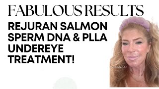 ✨ Rejuran Salmon Sperm DNA amp PLLA Undereye Treatment Fabulous Results ✨ [upl. by Decamp]