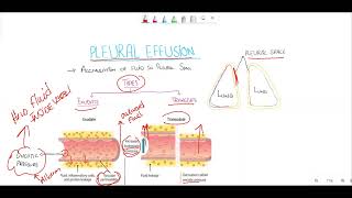 Pleural effusionTransudate vs exudate Light criteria [upl. by Gove]