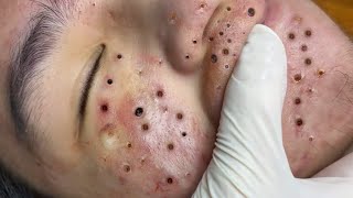 Remove Blackheads and Pustules on Chin [upl. by Acisej]