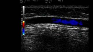 Phlebology Biosound Esaote MyLab 25 Proximal GSV with Reflux [upl. by Attaymik176]