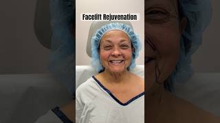 Patient Looks Years Younger After Facelift [upl. by Inahpets]