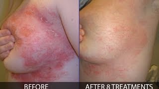 How to treat psoriasis effectively  By Franziska Ringpfeil Board Certified Dermatologist [upl. by Neukam]