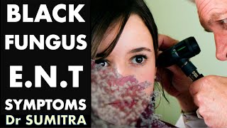 Black Fungus  ENT symptoms  Mucormycosis  Dr Sumitra [upl. by Eitsud]