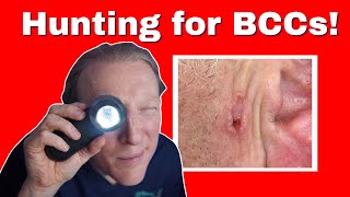 BCC Basal Cell Carcinoma Skin Cancer What You NEED to KNOW [upl. by Lamak]