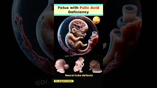 How Folic Acid Deficiency Leads to Neural Tube Defects in Pregnancy shortsviral pregnancy vitamin [upl. by Mayes]