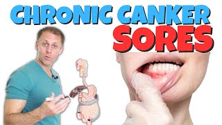 Dealing with Chronic Canker Sores [upl. by Attena]