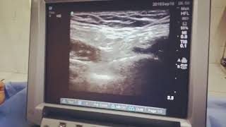 US guided genitofemoral nerve block [upl. by Acirehs]