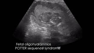 CASE 973 Fetal oligohydramnios POTTER sequence syndrome [upl. by Sirtemed275]