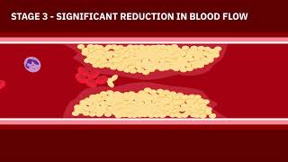 Coronary Artery Disease Animation [upl. by Kaliope]