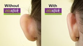 New Otostick Cosmetic Ear Correctors  A solution for prominent ears [upl. by Anitap175]