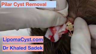 Pilar Cyst Removal Dr Khaled Sadek LipomaCystcom [upl. by Brownson]