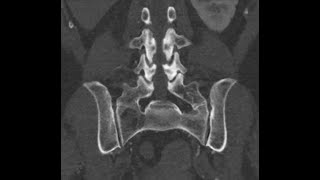 L5 Sacralization and Bertolotti syndrome  an underestimated condition [upl. by Lledner398]