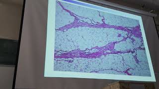 pathology practical hematoma [upl. by Ahsimal]