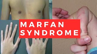 Marfan Syndrome  Pathology Clinical Presentation Diagnosis and Treatment [upl. by Ennylcaj659]