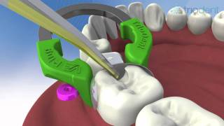 Class II composite restoration using V3 Sectional Matrix System  Triodent [upl. by Valeria63]