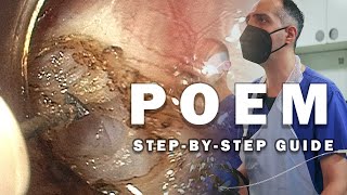 Mastering the POEM Technique for Achalasia A StepbyStep Guide [upl. by Arraes]