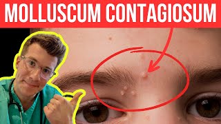 Doctor explains Molloscum Contagiosum viral skin infection  Causes symptoms and treatment [upl. by Erialb748]