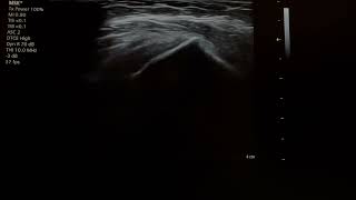 subacromial bursitis injection 24110101 [upl. by Enneirdna]