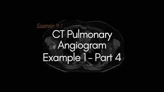 CT Pulmonary Angiogram  Example 1  Part 4 radiologist radiology angiogram [upl. by Toback406]