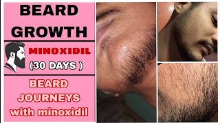 BEARD GROWTH  IN JUST 30 DAYS WITH THE HELP OF MINOXDIL 5 [upl. by Rew]