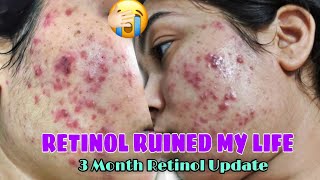 RETINOL SIDE EFFECTS MY 3 MONTH ACNE JOURNEY RETINOL BEFORE amp AFTERRETINOL JOURNEY [upl. by Hayward]