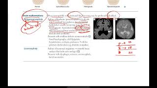 Neural tube defects Brain malformations  Neurology  2  First Aid USMLE Step 1 [upl. by Soinotna]