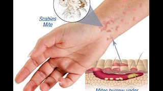 Scabies Causes Symptoms and Treatment [upl. by Dionne974]