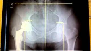 Hip Replacement Surgery and Short Leg Syndrome [upl. by Kyte]