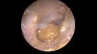 Ear Wax Removal Leicester  Mr Neel Raithatha The Hear Clinic [upl. by Wallas]