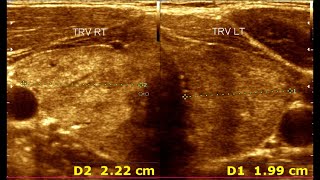 Understanding Ultrasonographic Features of Chronic Thyroiditis [upl. by Annabela]