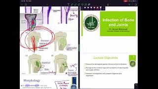 Osteomyelitis pathology amp microbiology [upl. by Amoihc]