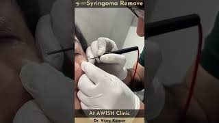 Syringoma removal by LASER syringoma treatment laser awishclinic delhi drvijaykumar shorts [upl. by Nyrok539]