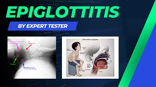 Epiglottitis  Causes  Symptoms  Diagnosis  Treatment amp Pathology [upl. by O'Dell]