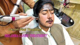 melasma laser treatment Carbon Peel Laser  4k video [upl. by Naloc178]