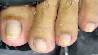 Toenail Ingrown Removal grabi ang kapit ng dryskin ni madam [upl. by Hung]