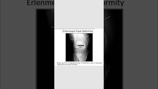 Erlenmeyer flask deformityradiology orthopedics [upl. by Okikuy]