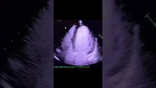 Diagnosis echocardiography [upl. by Amada]