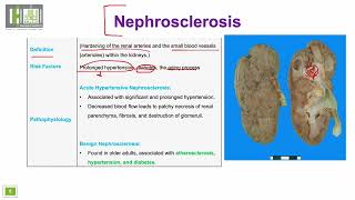 تصلب الكلية  Nephrosclerosis [upl. by Ramilahs]