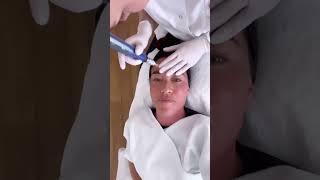 SkinPen microneedling behandeling in Amsterdam met Naomi van As [upl. by Anayra653]