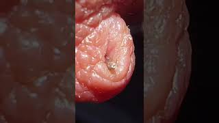 Satisfying 100 Neddle Removal super fast😍 [upl. by Georgiana568]