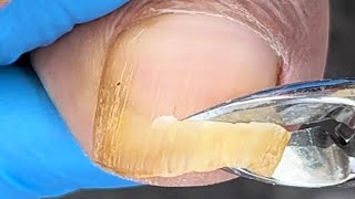 Extra long ingrown toenail treatment process One time cutting and super decompression [upl. by Borrell234]